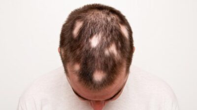 What There is To Know Concerning Hair Loss