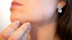 Practical Home Remedies For Pimples