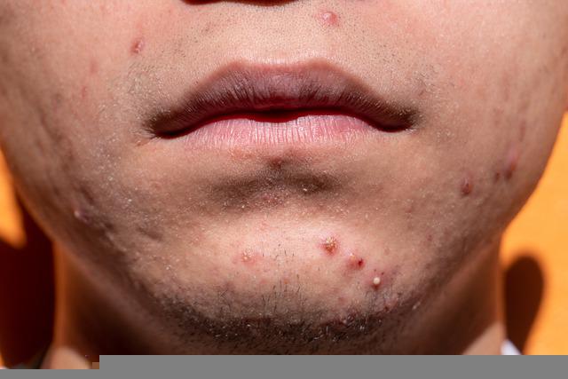 beat acne