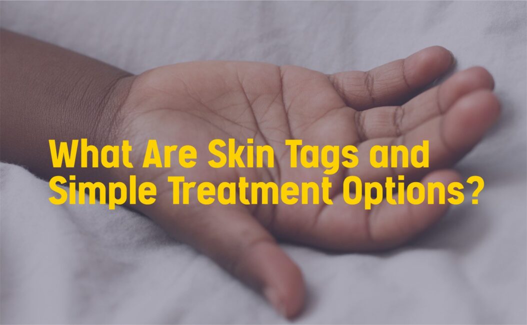 what are skin tag